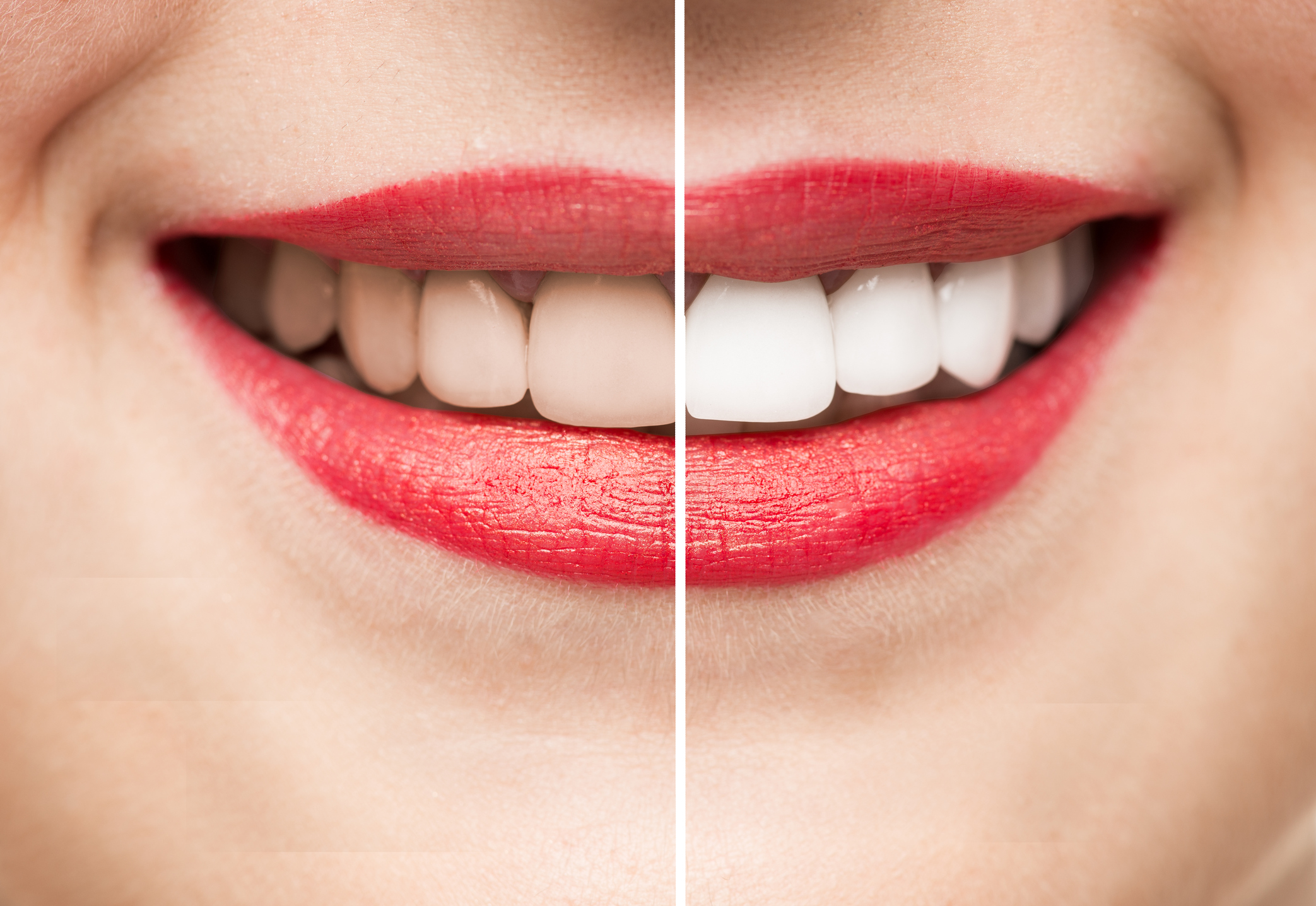 Teeth After and Before Whitening | Benson Dental Practice