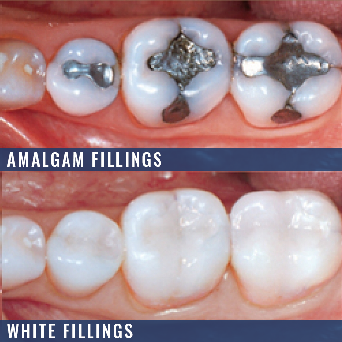 whitefillingsamalgamfillings Benson Dental Practice