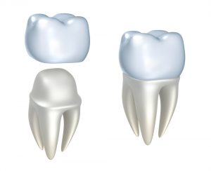 Dental crown example